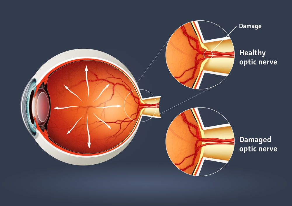 What are the risks of eye surgery for glaucoma?