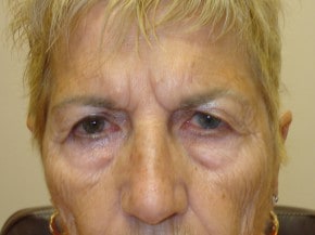 Before eyelid surery at Gulfcoast Eyecare