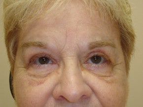 After gallery photo eyelid surgery
