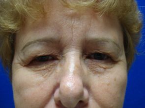 Before eyelid lift at Gulfcoast Eyecare