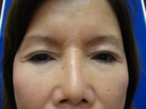 Before eyelid surgery gallery