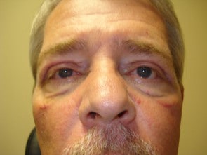 Gulfcaost Eyecare after eyelid surgery