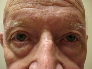 Man after eyelid surgery at Gulfcoast Eyecare