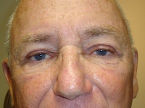 Man after recieving eyelid surgery at Gulfocast Eyecare