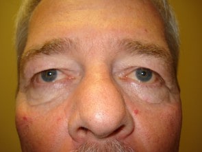 Man before eyelid surgery