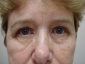 Woman after eyelid surgery at Gulfcoast