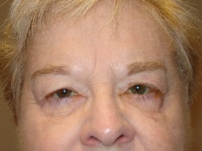Woman after Gulfcoast Eyecare eyelid surgery