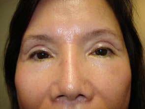 Woman's eyelids before eyelid surgery