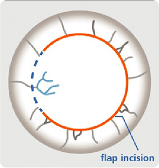 LASIK Flap Surgery