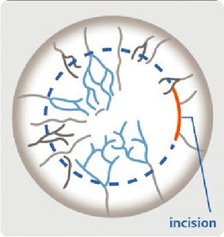 Smile Surgery Incision