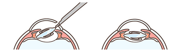 Clear Vision after Cataract Surgery at Gulfcoast Eyecare