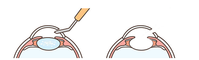 Cloudy Lens Removal in Cataract Surgery at Gulfcoast Eyecare