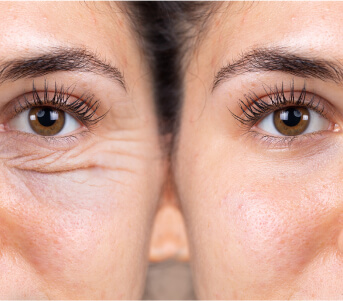 Before and After Eyelid Surgery at Gulfcoast Eye Care