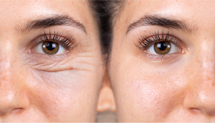 Before and After Eyelid Surgery at Gulfcoast Eye Care