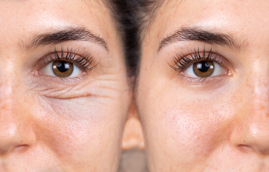 Before and After Eyelid Surgery at Gulfcoast Eye Care