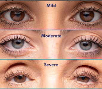 types of eye lid mild to servere