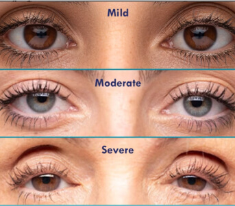 types of eyelid mild to servere