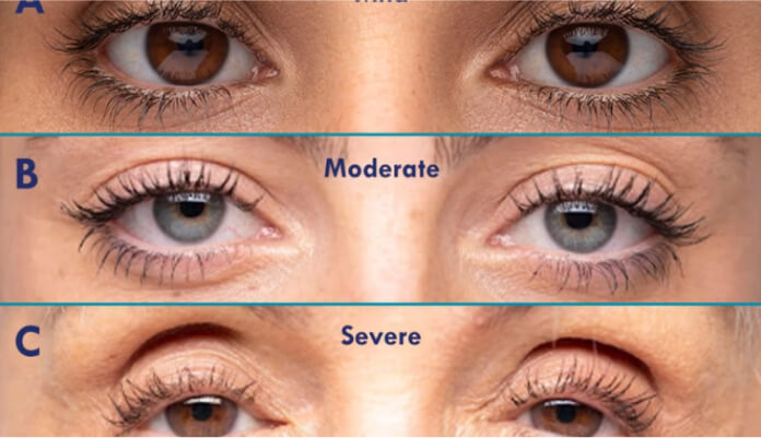 types of eye lid mild to servere