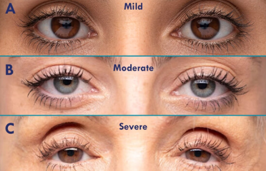 types of eye lid mild to servere