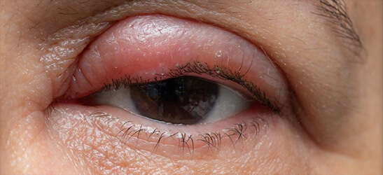 Eyelid Bumps examples at Gulfcoast Eye Care