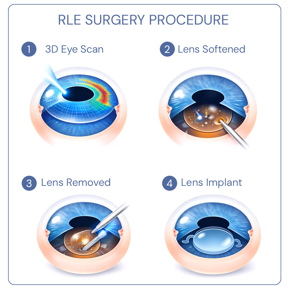 Diagram of the RLE surgery procedure: 3D eye scan, lens softening, lens removal, and artificial lens implant.