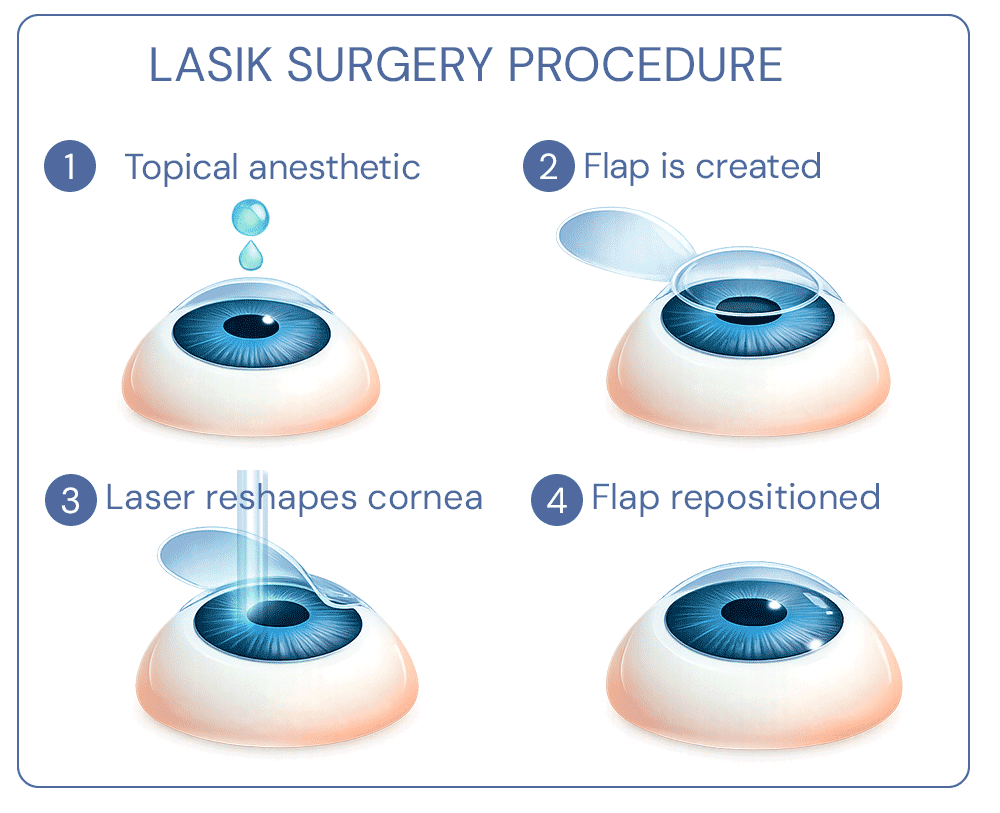 Diagram of the 4-step LASIK surgery procedure: 1. Topical anesthetic drops, 2. Corneal flap creation, 3. Laser reshaping the cornea, and 4. Repositioning the flap.