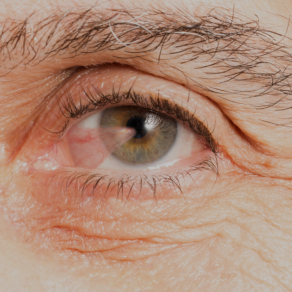 large-pterygium-needs-surgery-if-affecting-sight