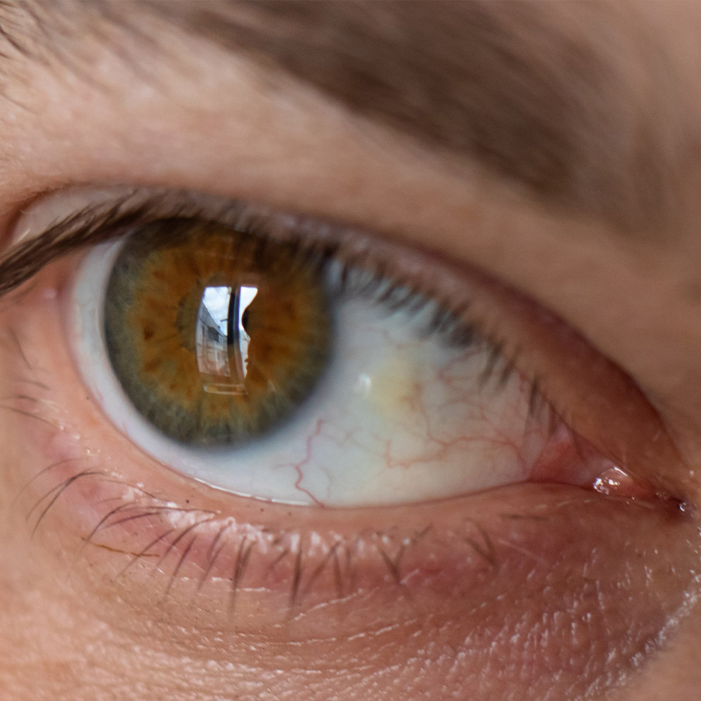small-pterygium-needs-eye-drops-for-inflammation-discomfort